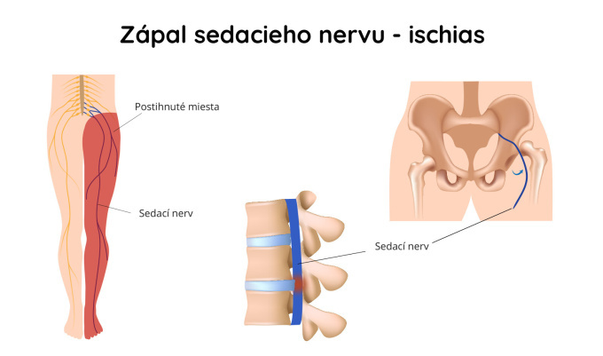 Ischias