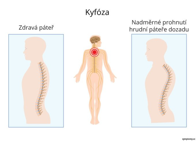Kyfóza