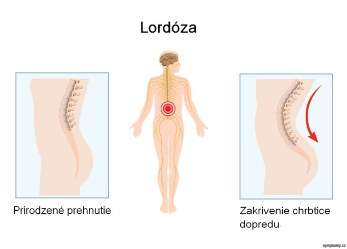 Lordóza