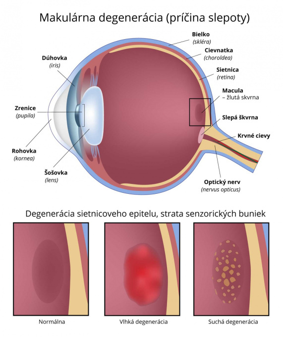 Makulárna degenerácia.jpg
