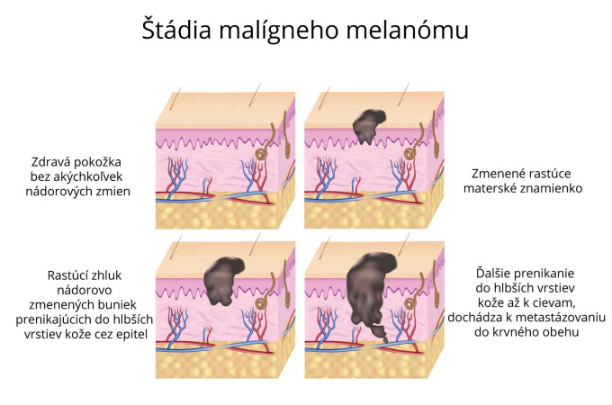 Stádia maligného melanómu