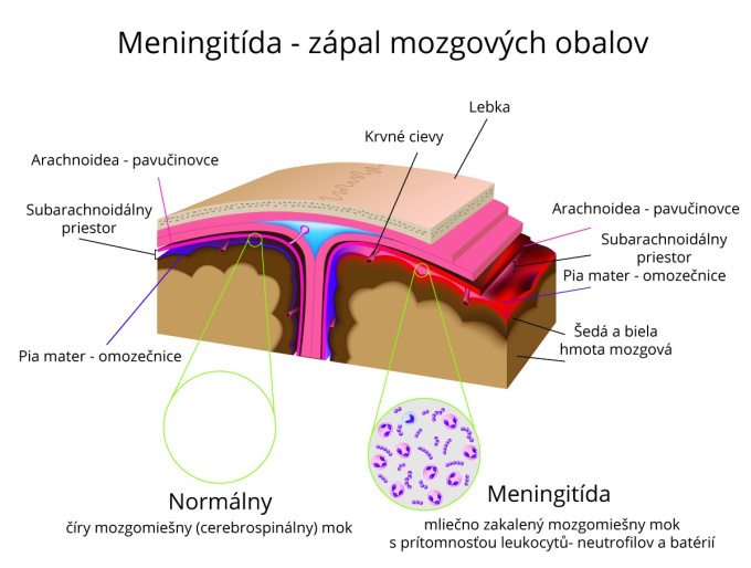Meningokokova meningitida
