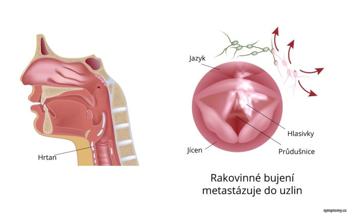 Metastázy