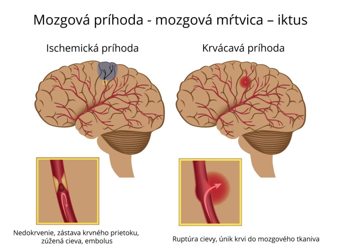 Mozgová príhoda.jpg