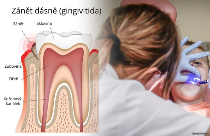 Nebezpečná paradentóza - ako sa jej vyhnúť?