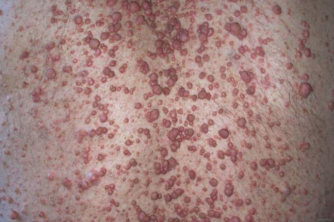 Neurofibromatóza