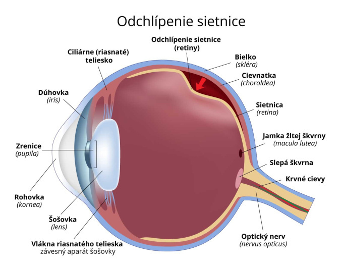 Odchlípenie sietnice.jpg