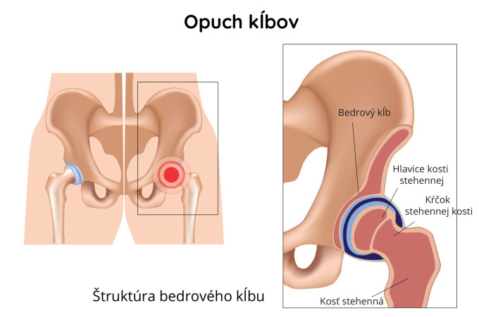 Opuch kĺbuv