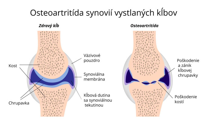 Osteoartritída synovií vystlaných klbov.jpg