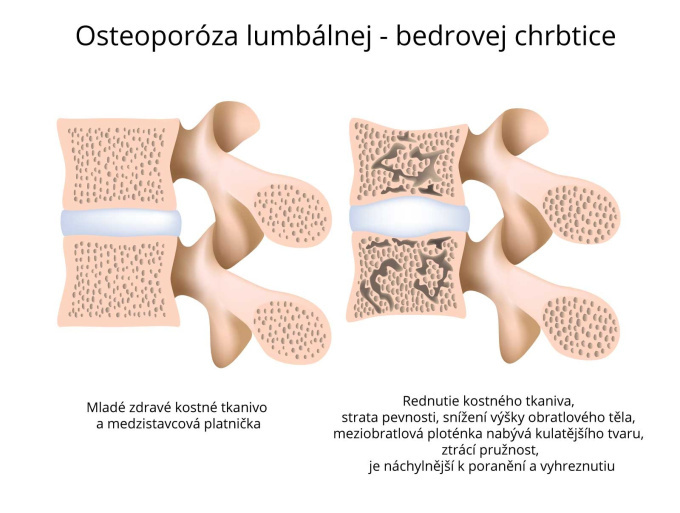 Osteoporóza lumbálnej-bedrovej chrbtice.jpg