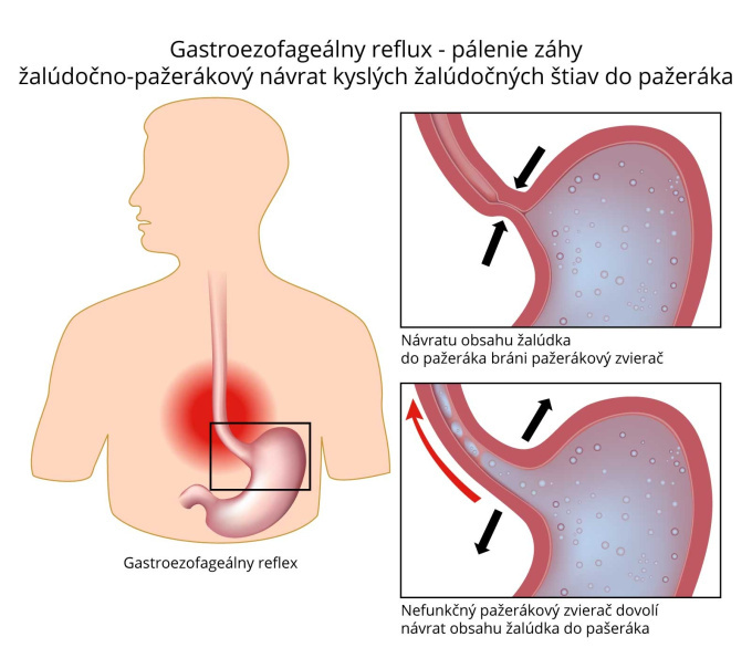 Pálenie záhy