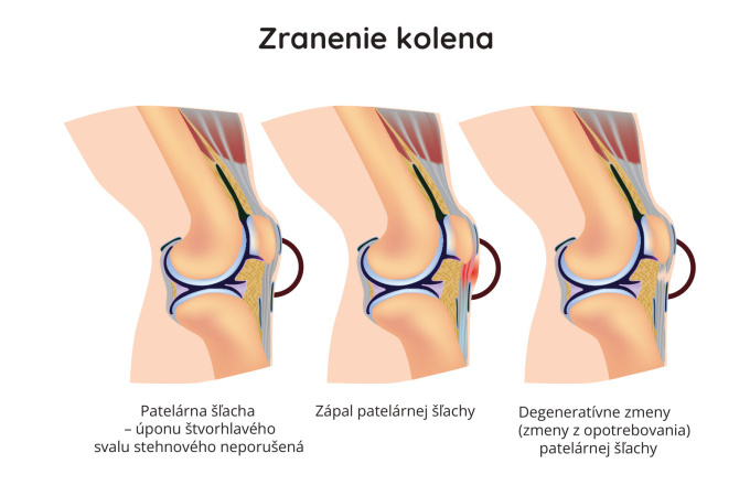 Zranenie kolena