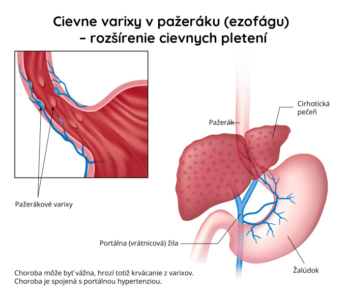 Pažerákové varixy