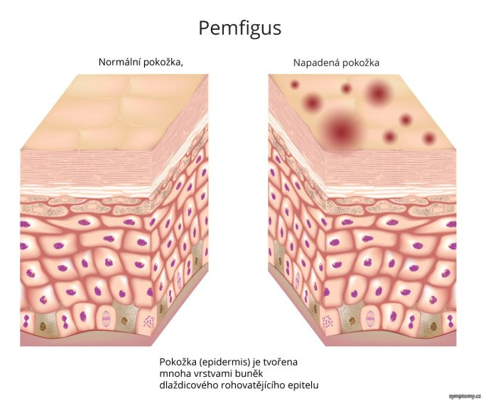 Pemphigus