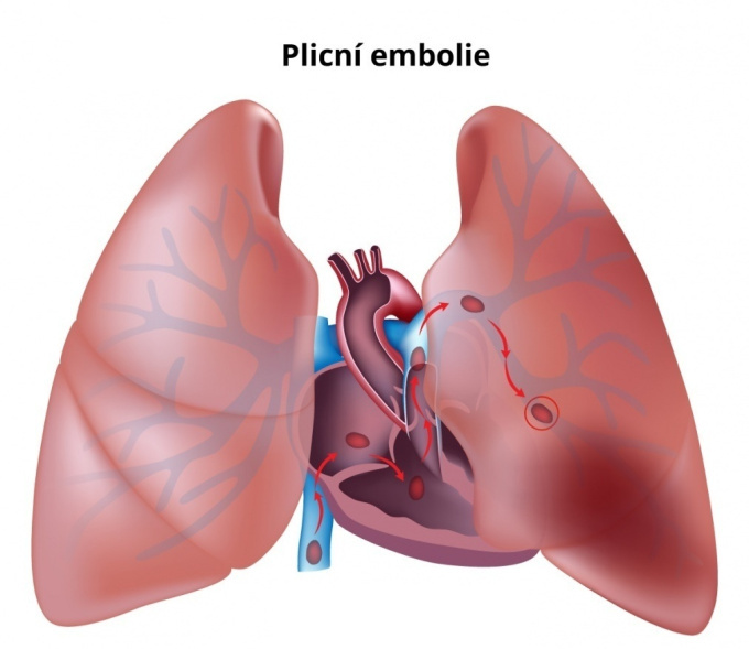 Pľúcne embolie