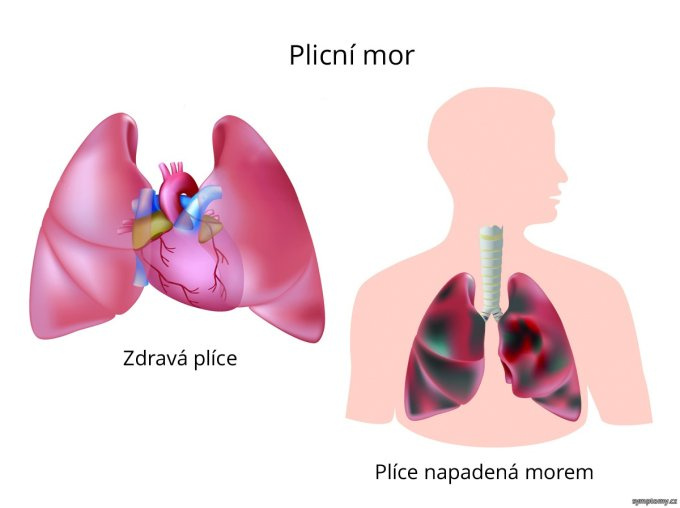 Pľúcny mor