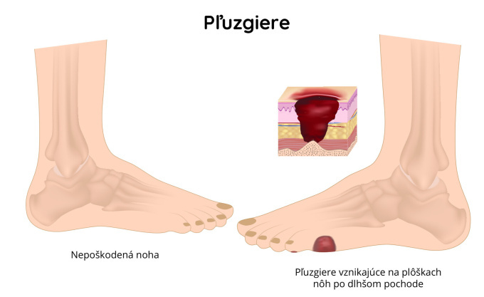 Pľuzgiere