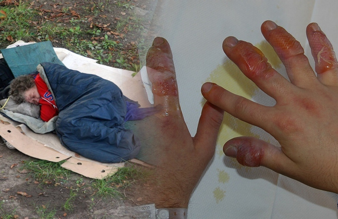 Priznaky podchladení hypotermie