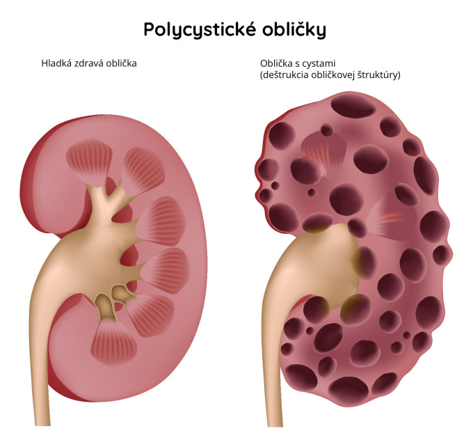 Polycystická choroba obličiek