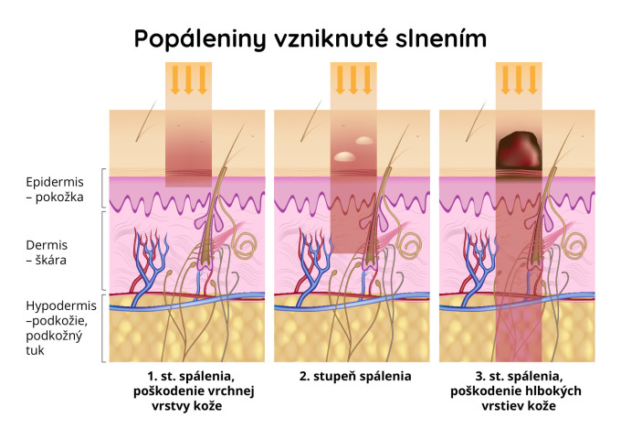 Popáleniny od slnka