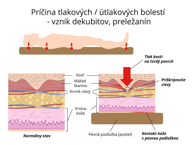 Príčina tlakových - útlakových bolestí