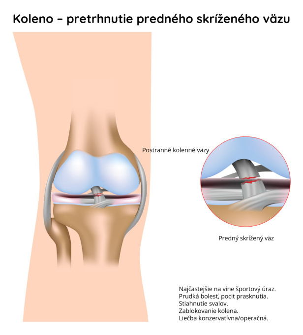 Pretrhnutie predného skríženého väzu 