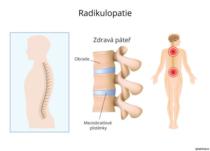 Radiculopthia