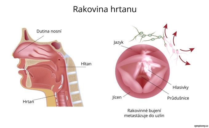 Rakovina hrtana
