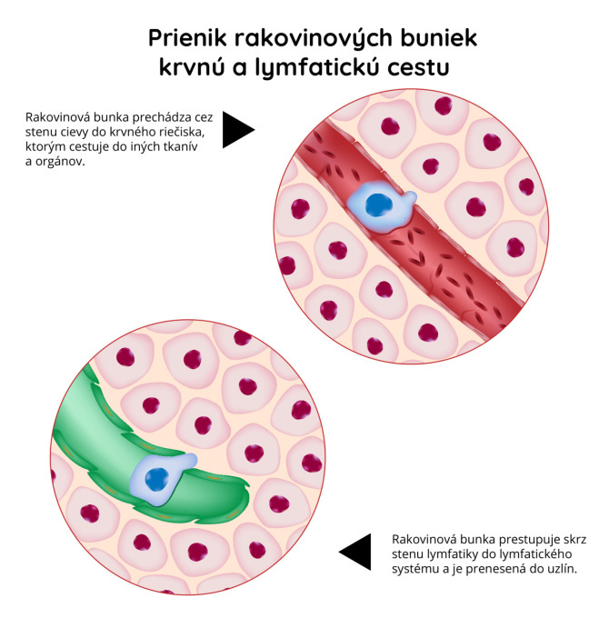 Prienik rakovinových buniek krvný a lymfatickú cestou
