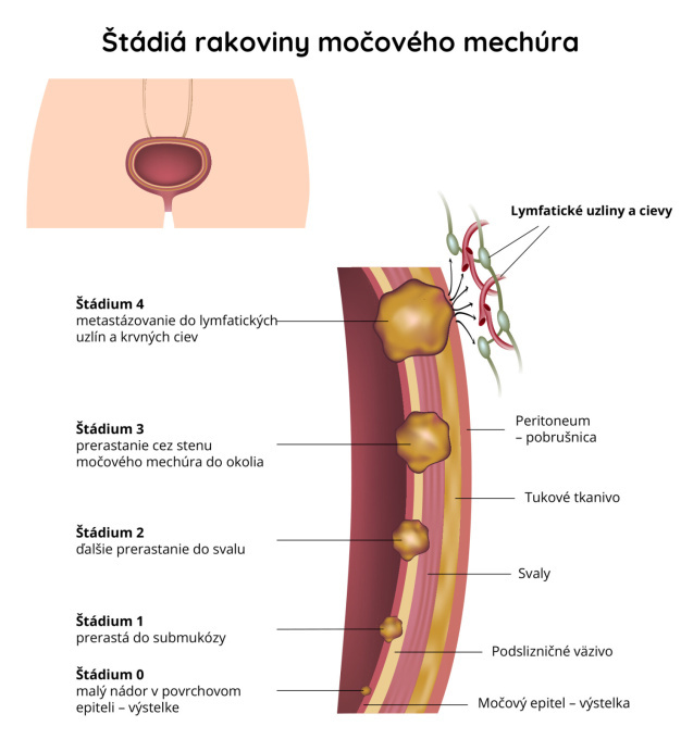 Rakovina močového mechúra