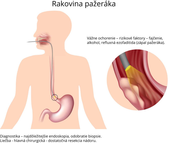 Rakovina pažeráka