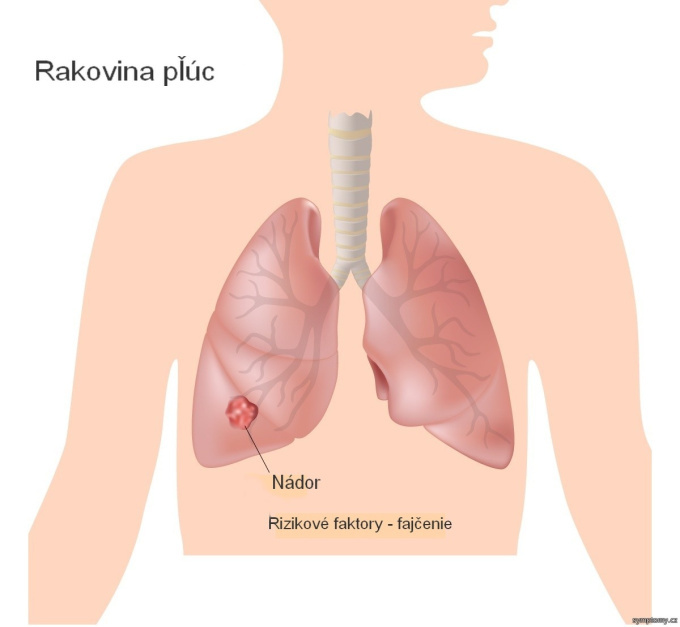 Rakovina plúc