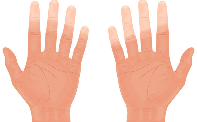 Raynaudova choroba a syndróm