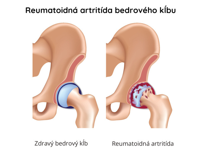 Reumatoidná artritída bedrového kĺbu