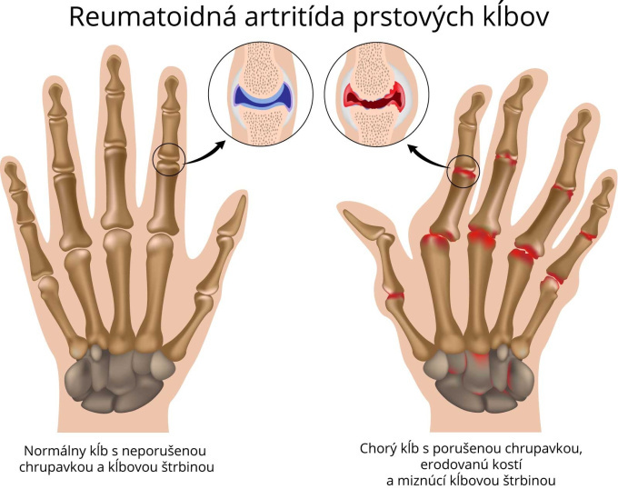 Reumatoidná artritída prstových klbov.jpg