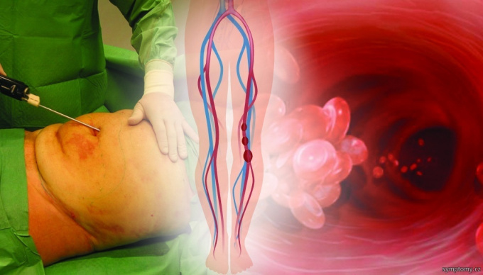 Liposukcia