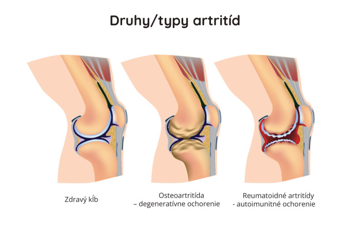 Druhy / typy artritíd