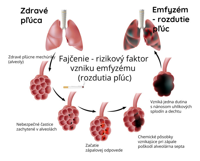Fajčenie - rizikový faktor -rozedma plic