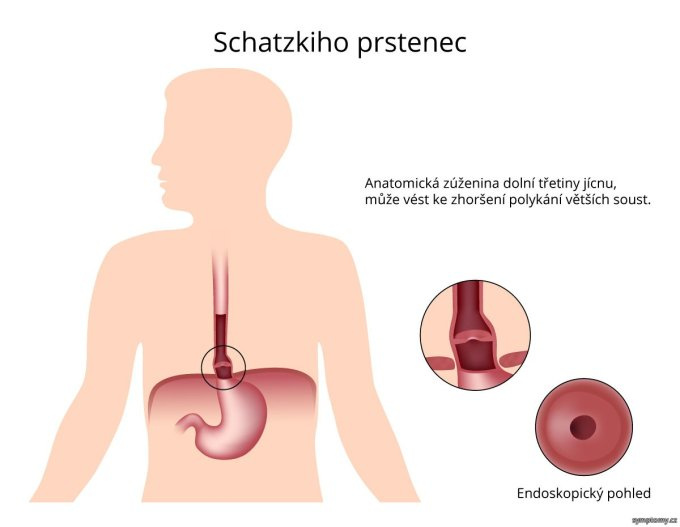 Schatzkiho prstenec