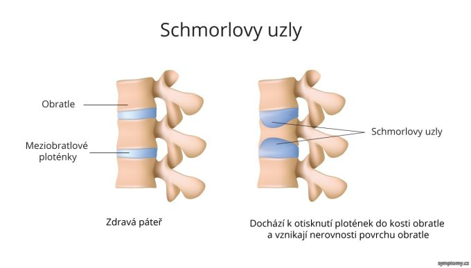 Schmorlovy uzly