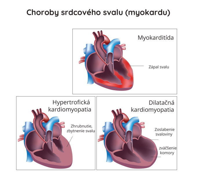 Srdcové zlyhanie 