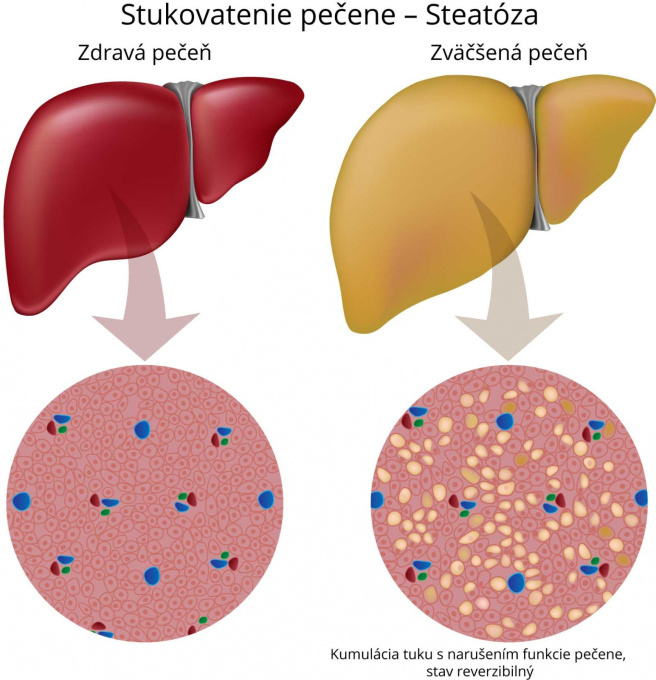 Stukovatenie pečeně - steatóza