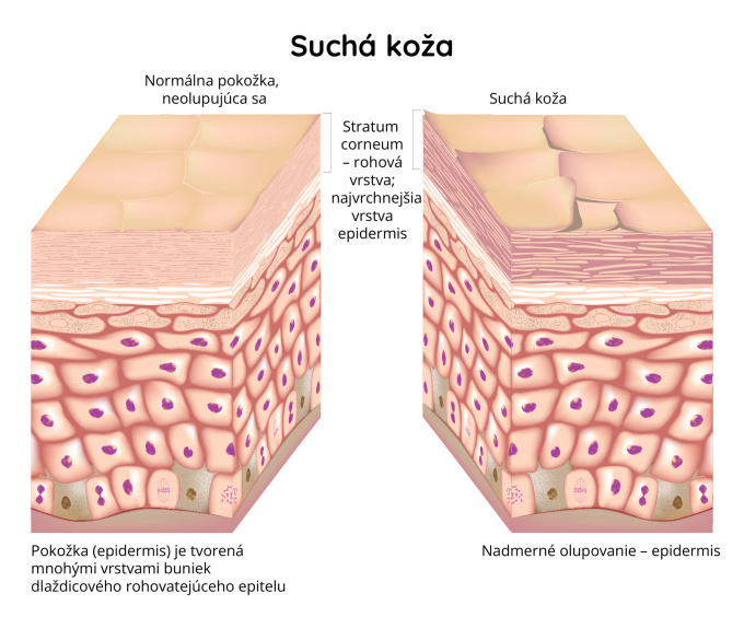 Suchá koža