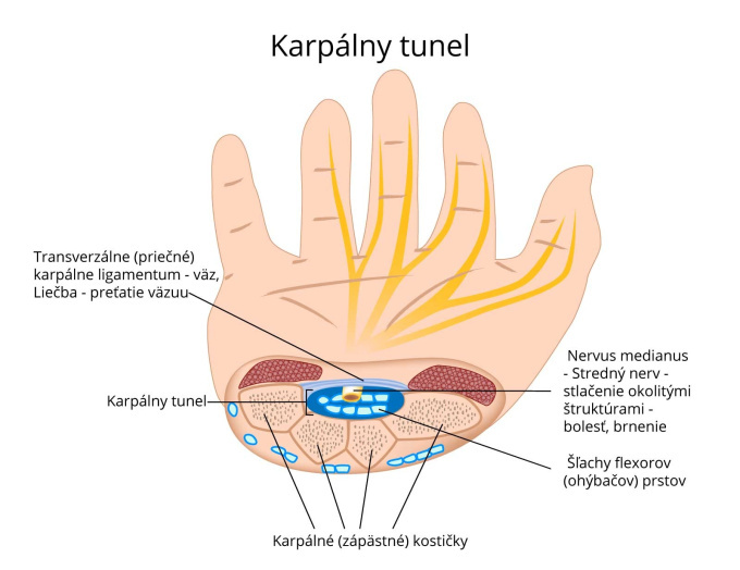 Karpálny tunel.jpg