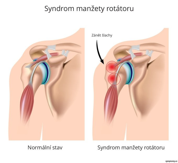 Syndróm manžety rotátora
