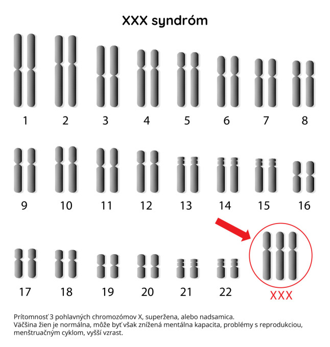 Syndróm XXX
