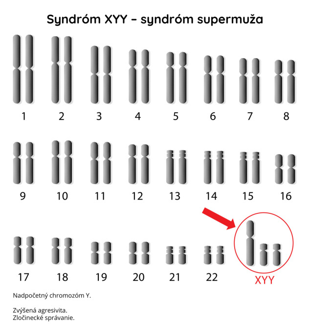 Syndróm XYY