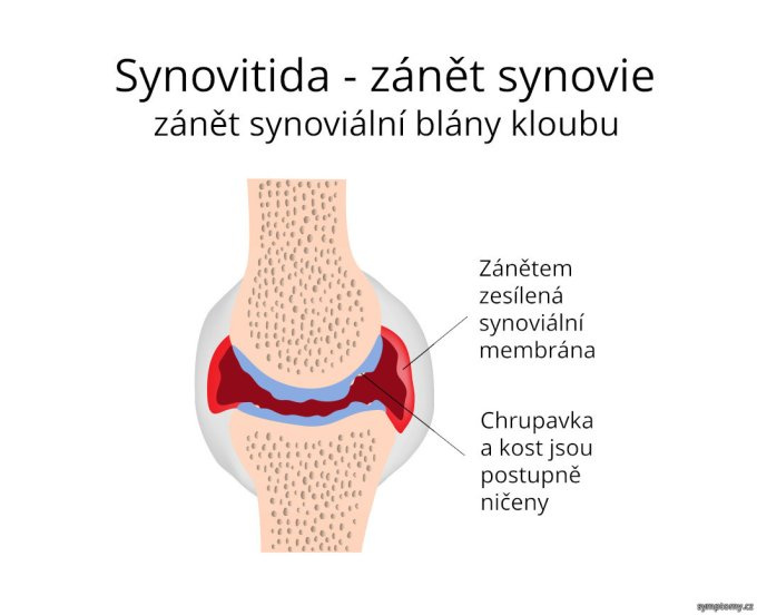 Synovitída