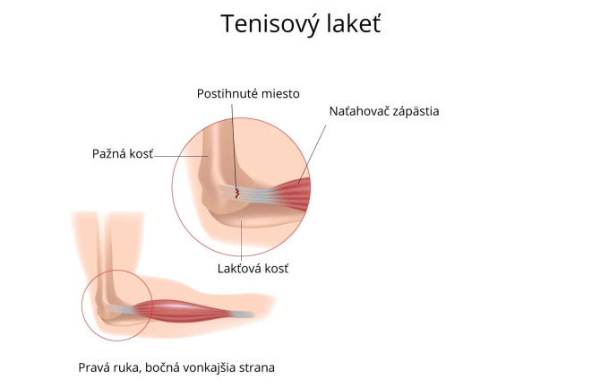 Tenisový lakeť