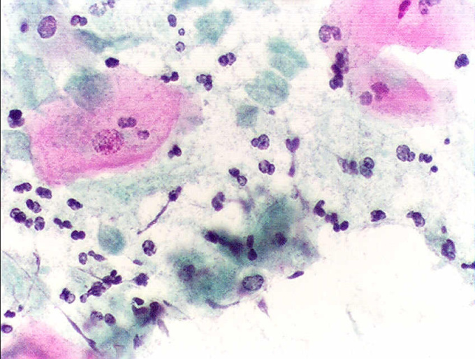 trichomonas-vaginalis